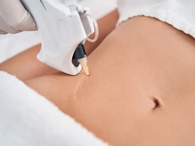 narbenkorrektur narbe bauch