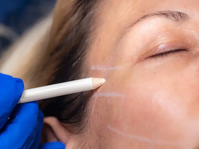 fadenlift markierung