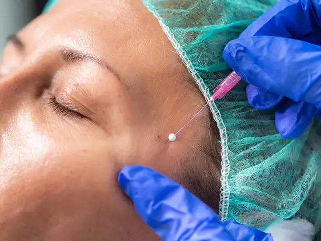 facelifting bildbeispiel