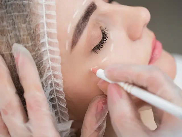 oberlidstraffung frau markierung